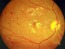 Vitreoretinal